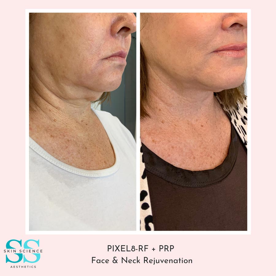 THE PIXEL8-RF – Skin Science Aesthetics | Tallahassee Skin Care