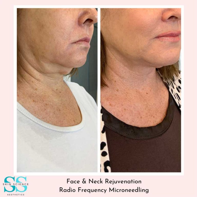 VIRTUE-RF – Skin Science Aesthetics | Tallahassee Skin Care